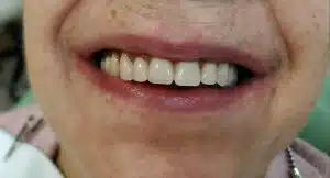 Colocamos los dientes fijos