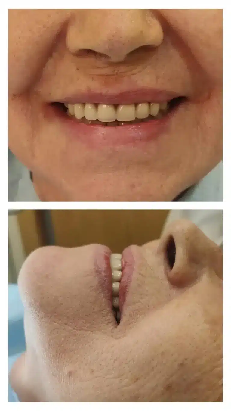 paciente despues de colocar dientes con implantes post extracción