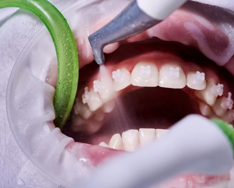 limpieza dental para mantener una buena higiene dental