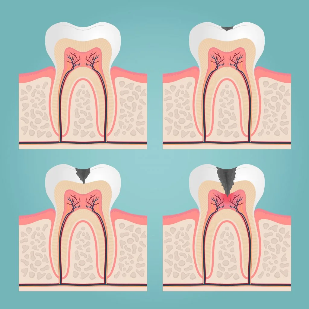 Evolucion de la caries dental