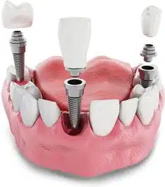 implantes unitarios de varios dientes