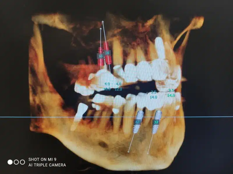 tac dental y simulacion 3d para coloacion de implantes