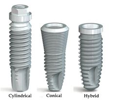 tipos de implantes dentales