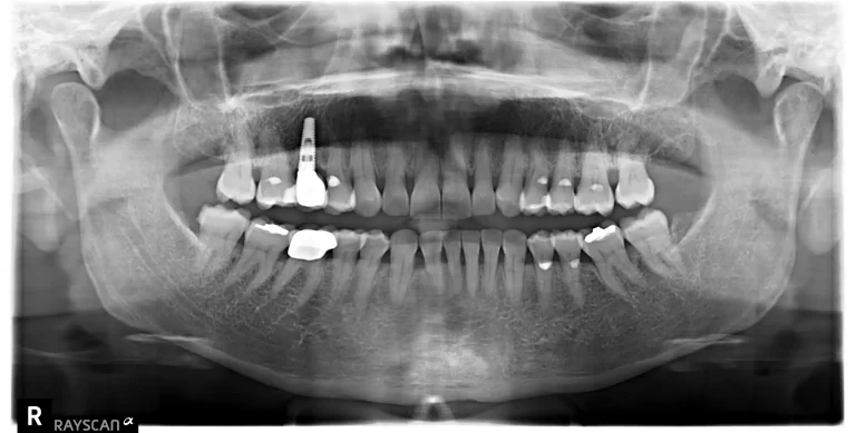 Radiografía para planificar un implante dental unitario en Sant Gervasi Barcelona