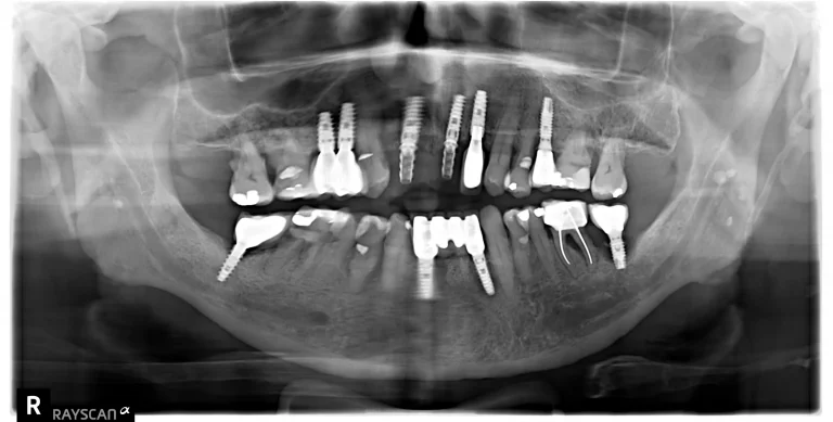 Mantenimiento de los Implantes Dentales