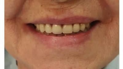 prótesis de toda la boca fija atornillada el mismo dia de colocar 5 implantes
