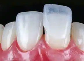 carillas dentales:la mejor opcion para una sonrisa natural
