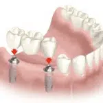 puente de tres piezas sobre 3 implantes