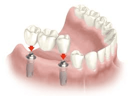 puente dental sobe dos implantes