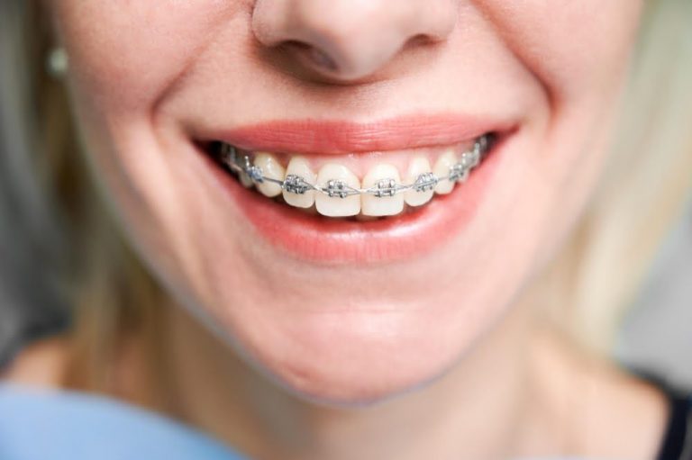 Paciente con brackets metálicos en tratamiento de ortodoncia en Sant Gervasi Barcelona