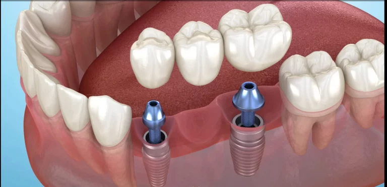 Puente fijo sobre implantes múltiples para reponer varios dientes perdidos