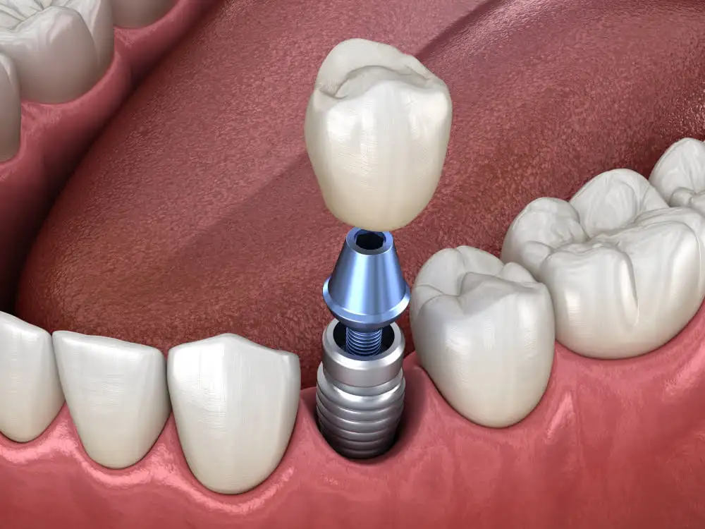 foto de implante dental unitario