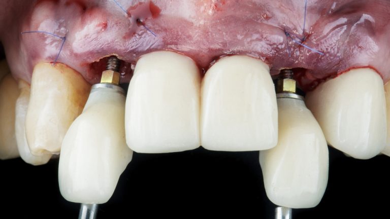 implantes inmediatos. colocacion de dos dientes en un día