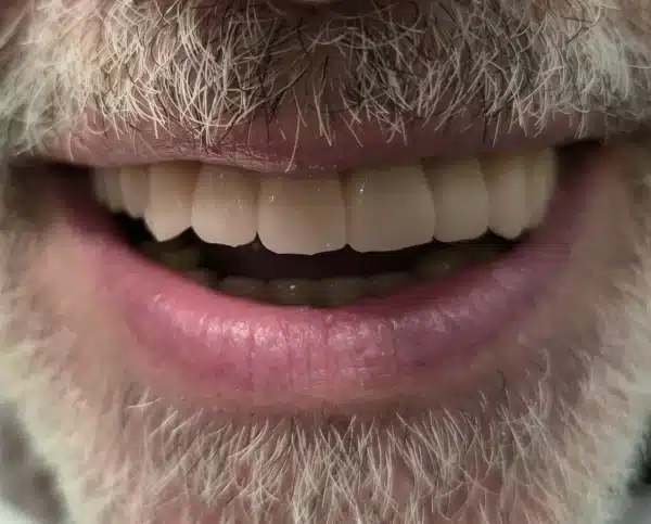 Resultado final tras rehabilitación de arcada completa