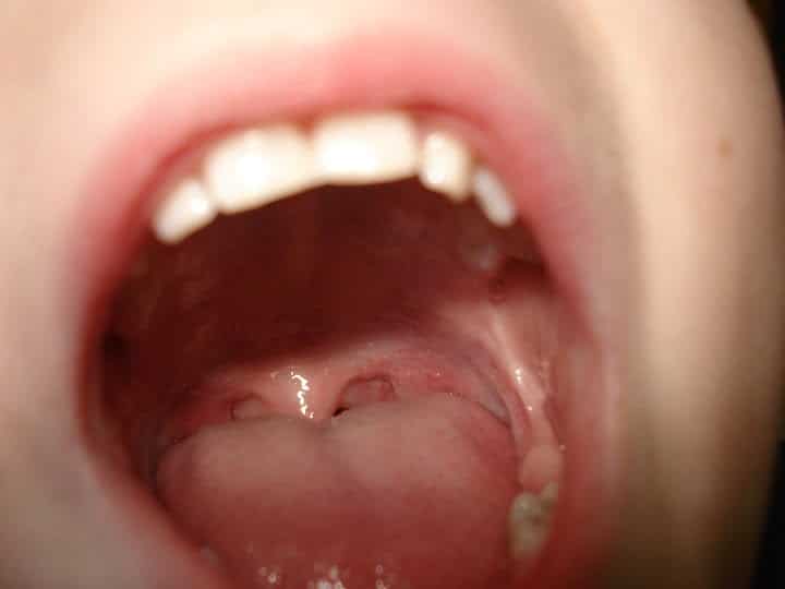 Síndrome de la boca ardiente o boca seca
