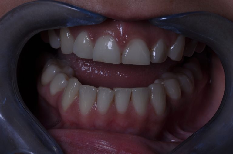 bruxismo dientes desgastados por el hábito de apretar los dientes