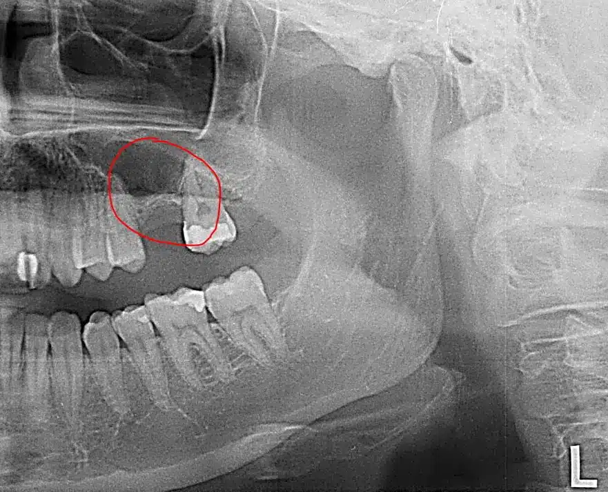 Ejemplo radiográfico: zona edéntula y planificación de regeneración/implante