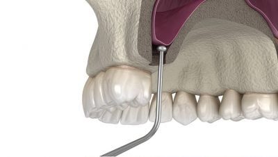 Elevación de seno atraumática