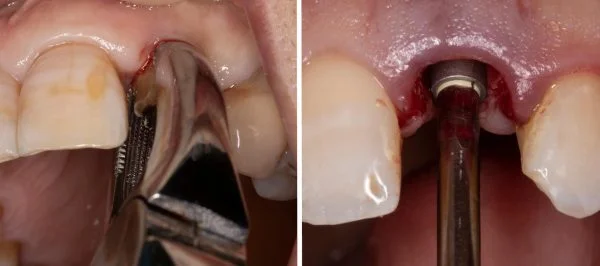 extracción del diente