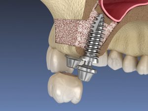colocación el implante dental 6 meses despues