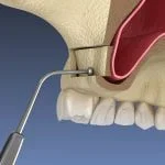 implantes dentales con poco hueso