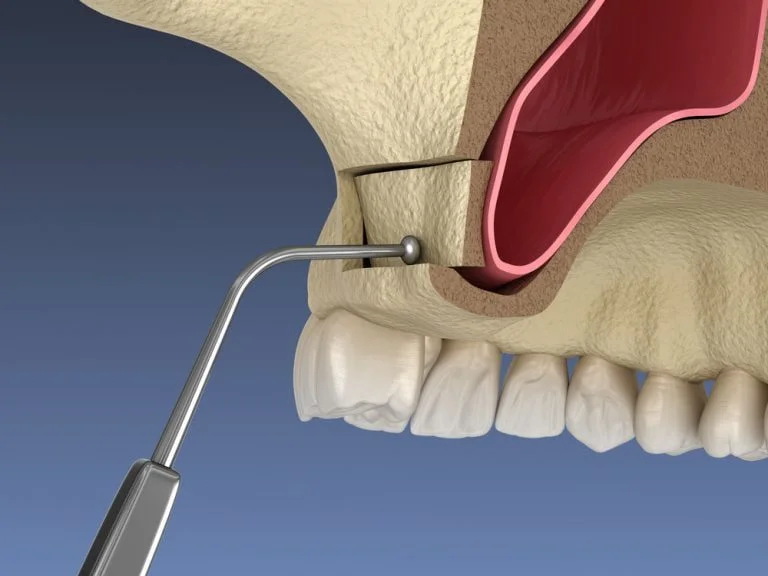 Implantes Dentales con Poco Hueso