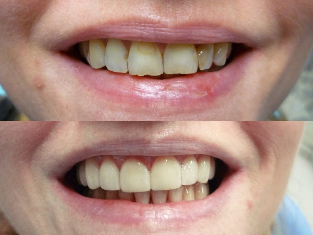 Antes y después de carillas dentales y mejora estética de la sonrisa