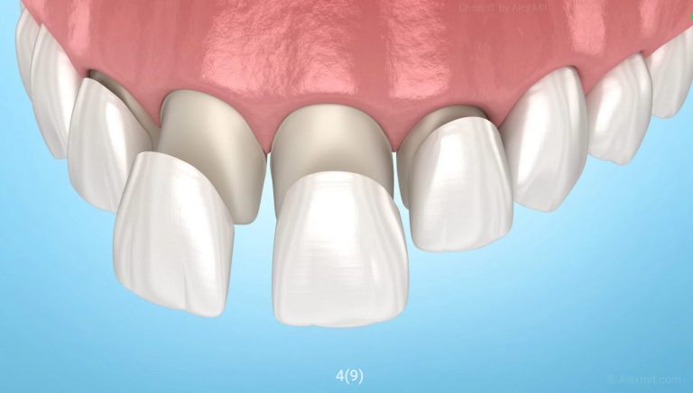 Reconstrucciones estéticas y diseño de sonrisa natural en Barcelona