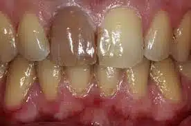 Alimentos y bebidas que manchan los dientes como café, vino y té