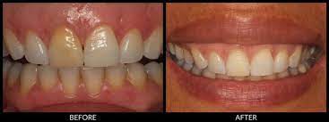 blanquamiento dental interno antes y despues