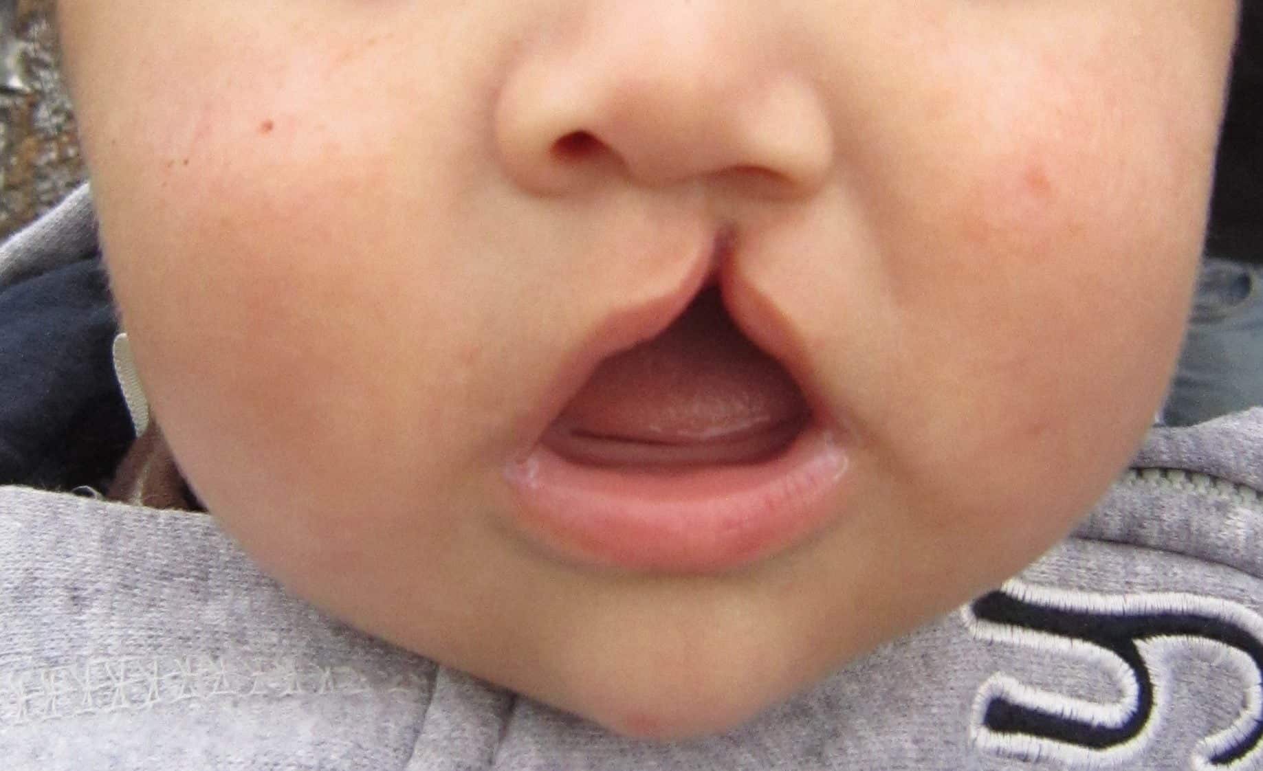 niño con labio leporino