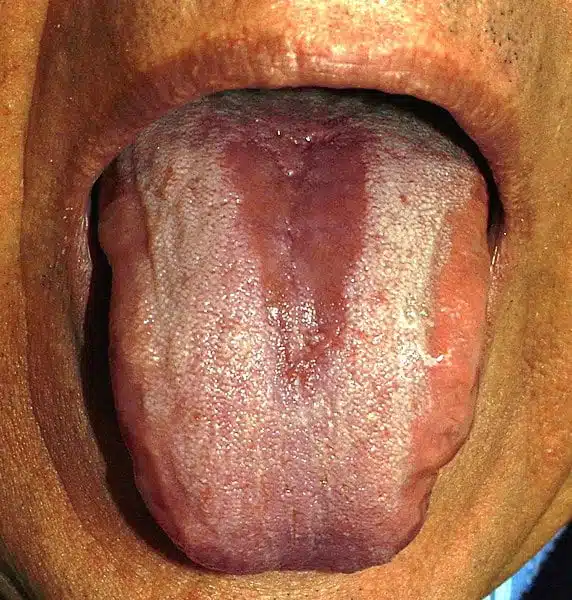 Lengua con candidiasis oral: placas blanquecinas en mucosa