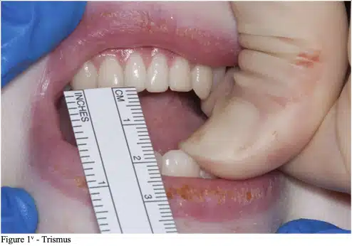 Trismus dental
