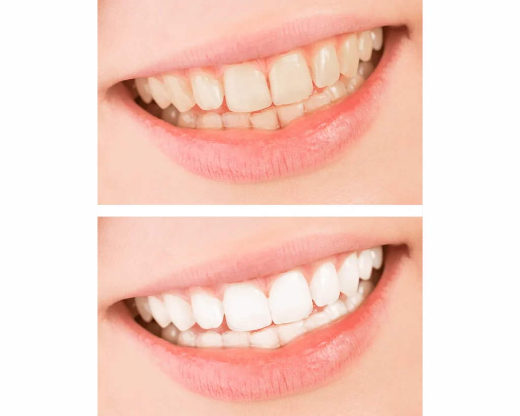 caso real blaqueamiento dental antes y despues