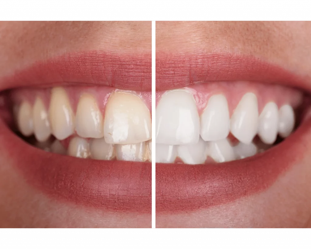 caso real blaqueamiento dental antes y despues