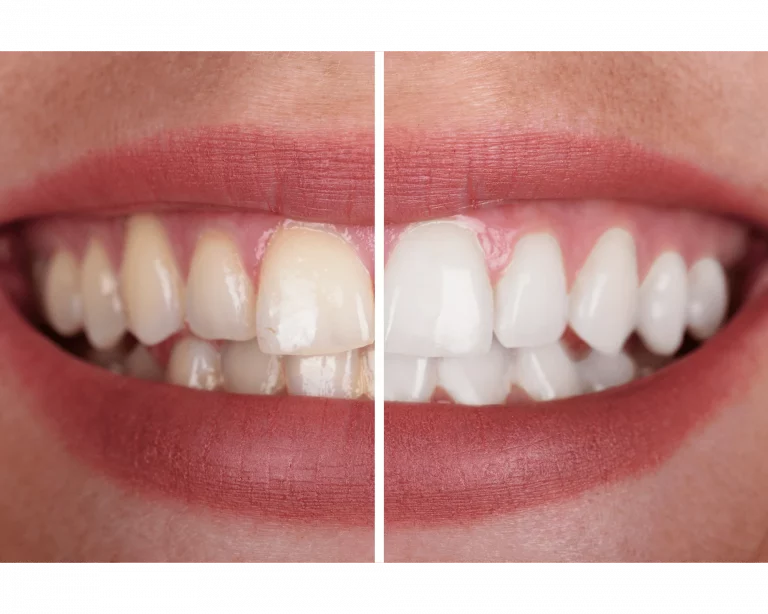 Blanqueamiento dental profesional antes y después en Sant Gervasi Barcelona