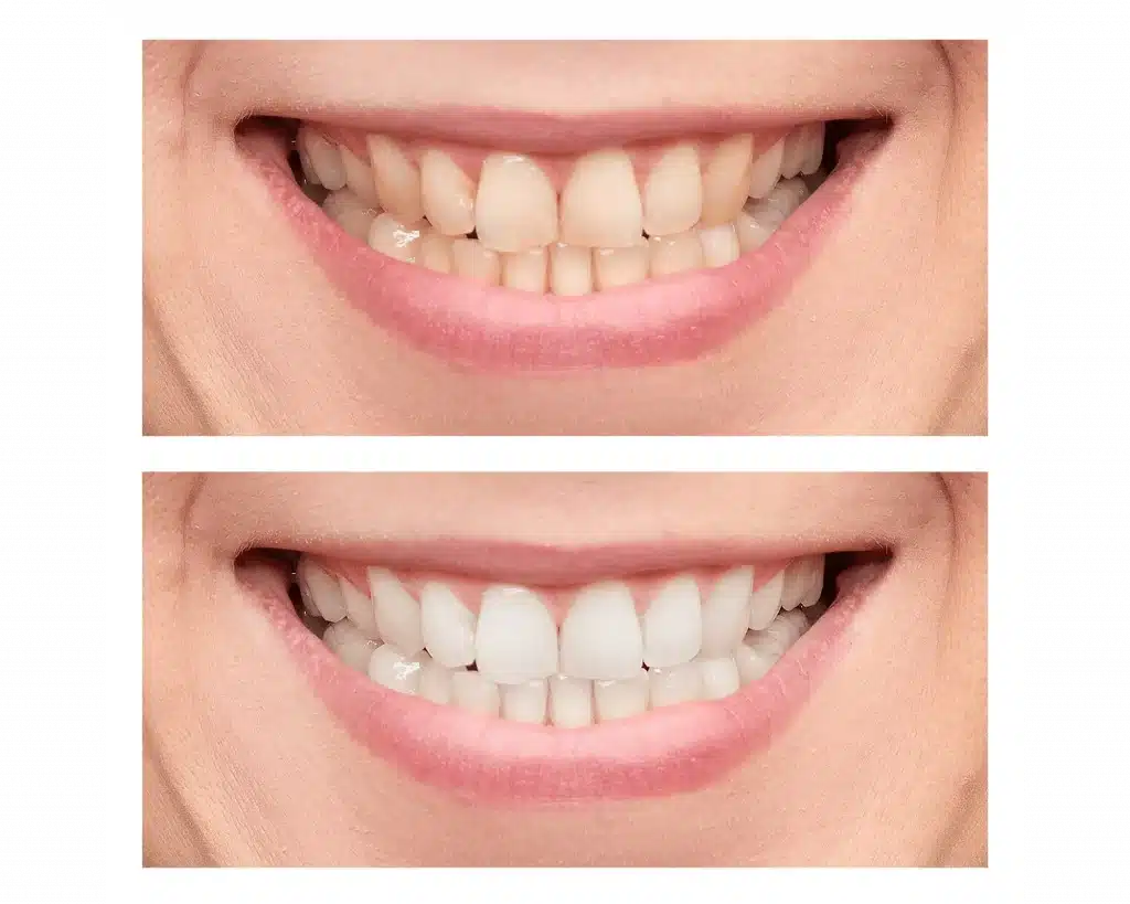 caso real blaqueamiento dental antes y despues