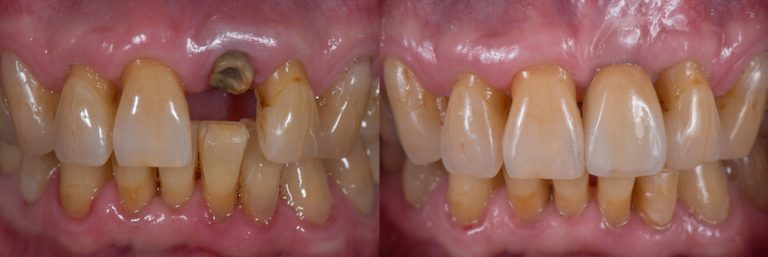 Corona unitaria sobre implantes