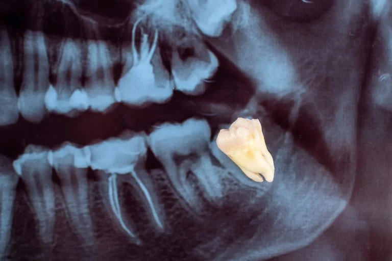 Paciente en tratamiento de implantes dentales con cirugía guiada en Barcelona