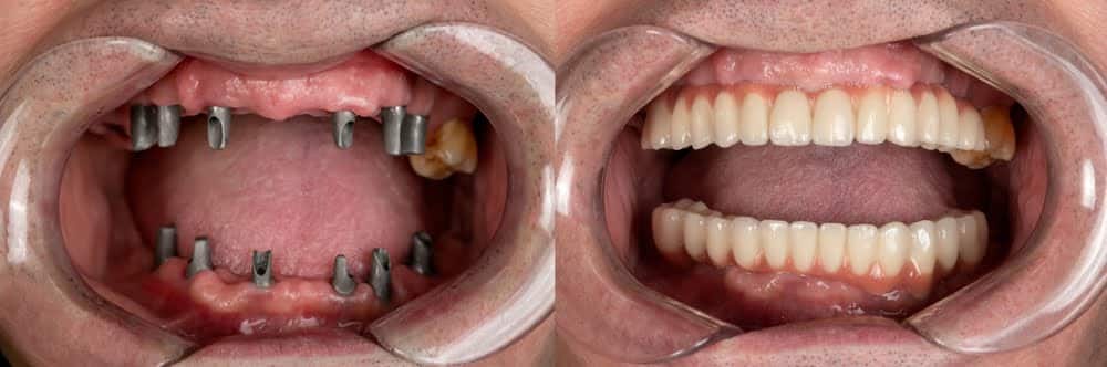 Rehabilitacion toda la boca con prótesis de cerámica