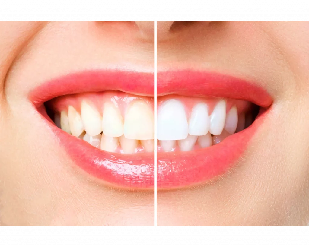 blanquamiento dental antes y depues
