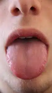 cancer de lengua