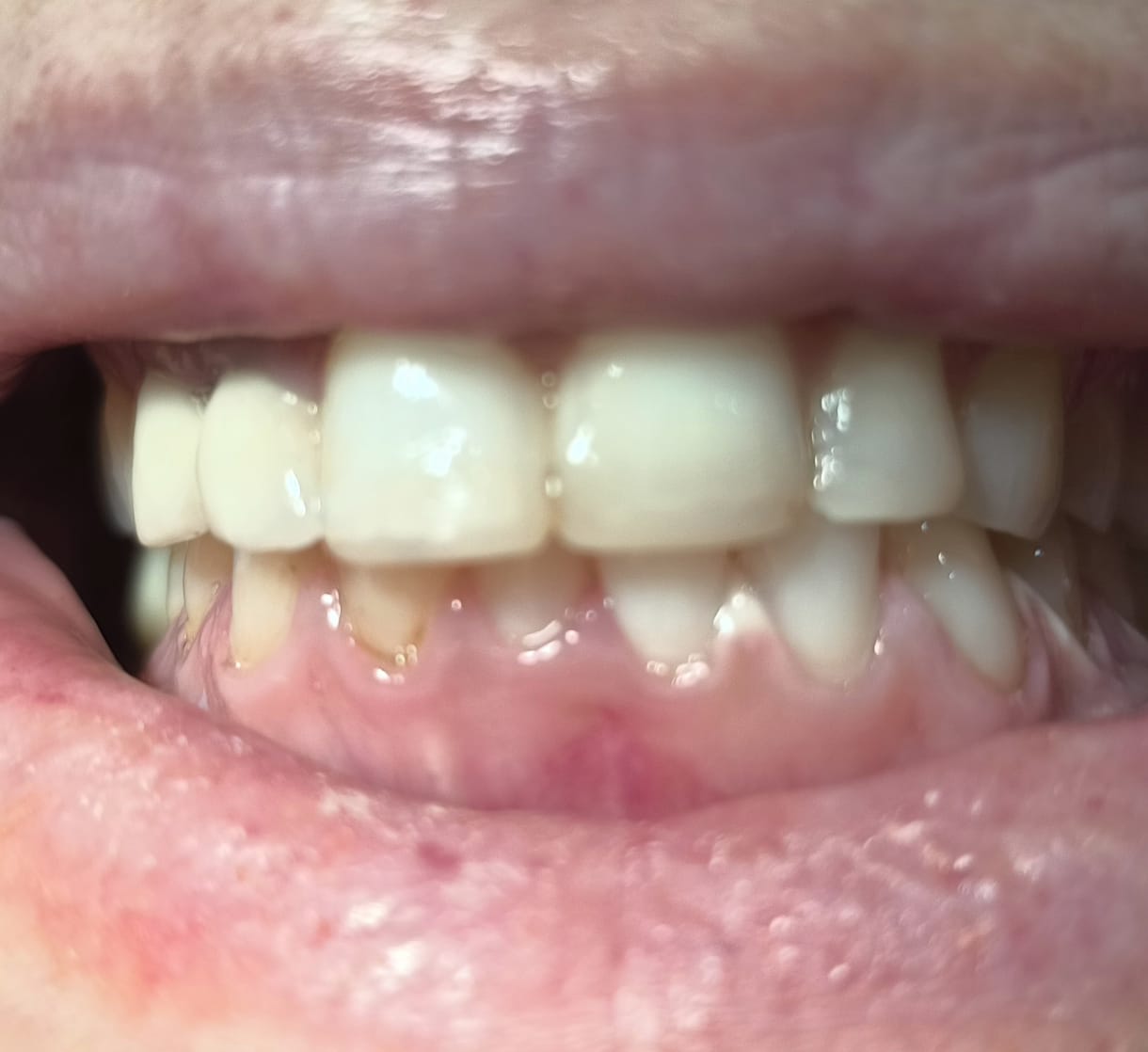 Resultado de blanqueamiento dental profesional antes y después