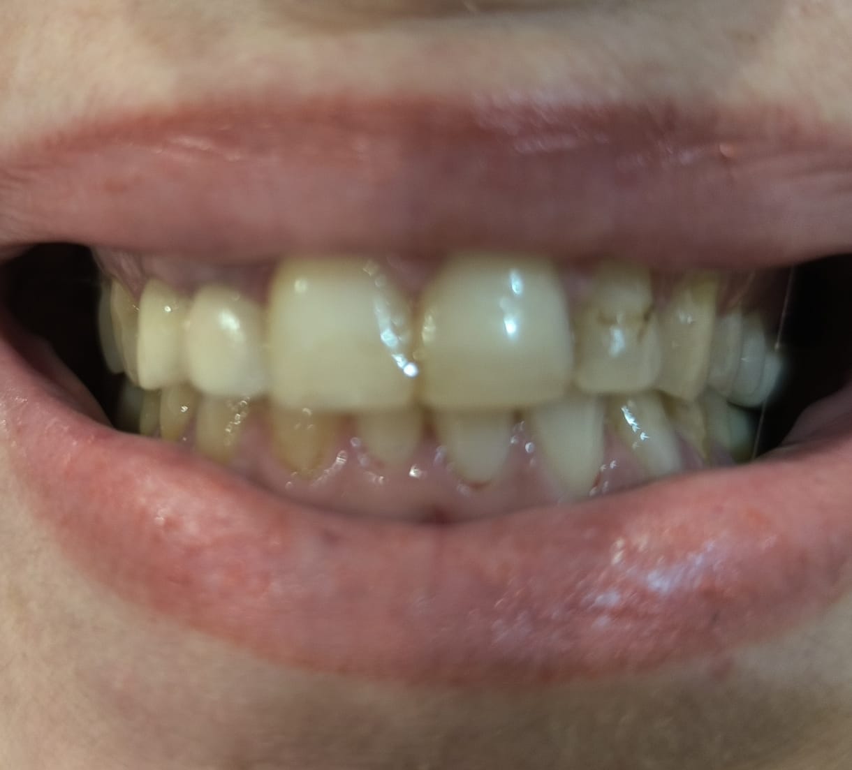Antes y después de blanqueamiento dental caso 1