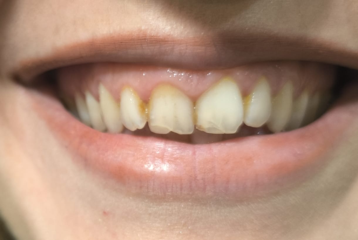 Antes y después de blanqueamiento dental caso 3