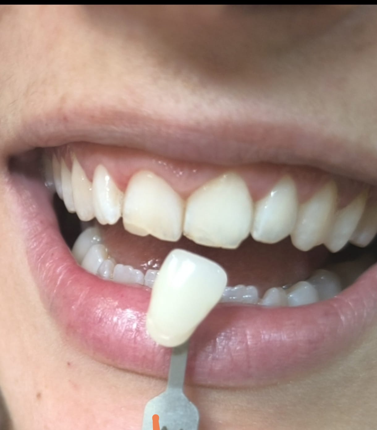 Antes y después de blanqueamiento dental caso 4