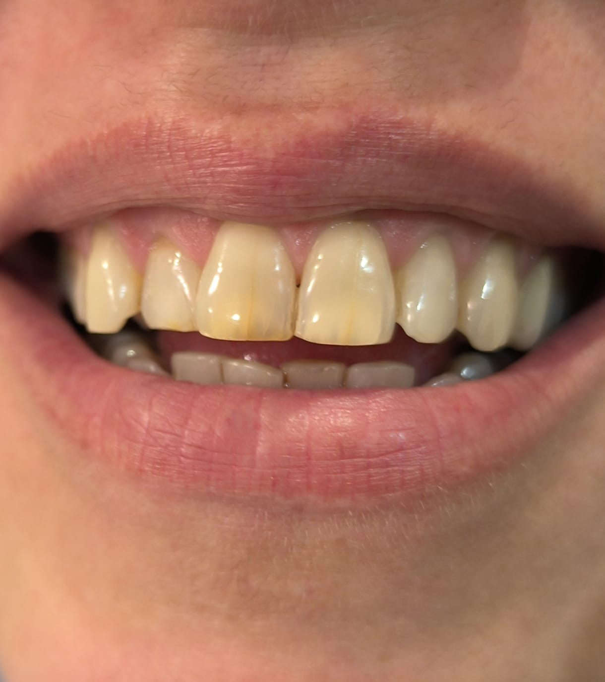Antes y después de blanqueamiento dental caso 5