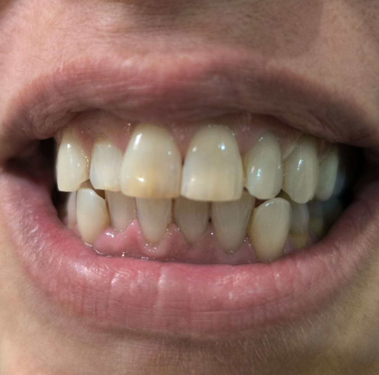 Antes y después de blanqueamiento dental caso 6