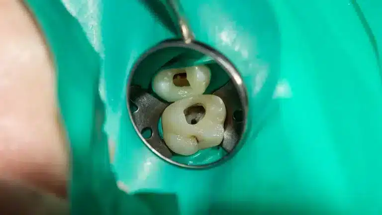 Endodoncia en Barcelona