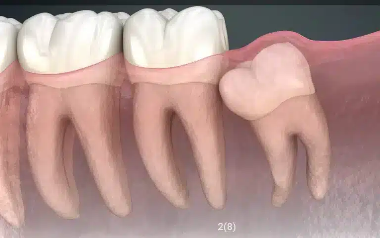 muela del juicio impactada sobre el segundo molar